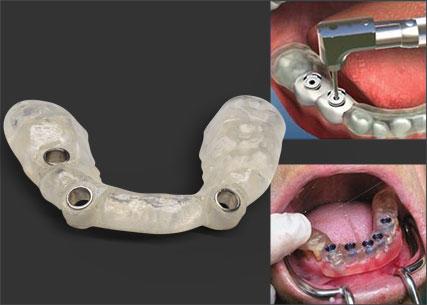 http://usglobalimages.stratasys.com/en/Resources/Case%20Studies/Dental/Protaico/headerImage_427.jpg?v=635659706527237300